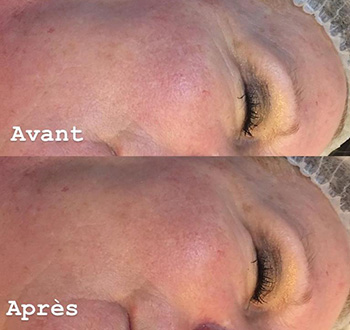 Peeling dermatologique Lille