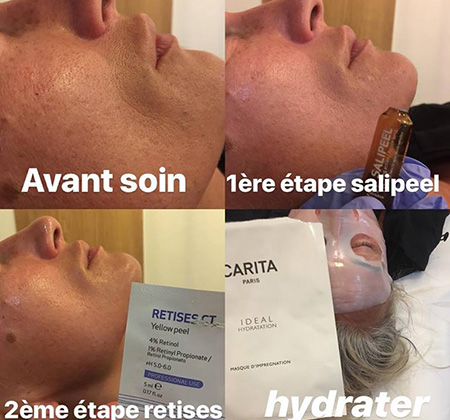 Soin peeling pour Homme